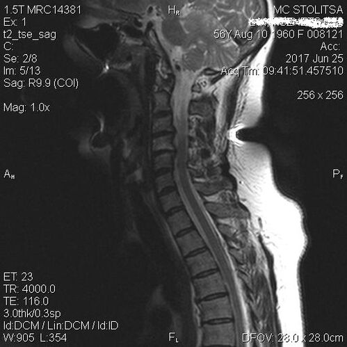 A nyaki gerinc osteochondrosis és spondilózis