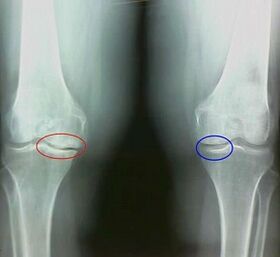 Az ízületi gyulladás és arthrosis népi gyógyszerek kezelésének eredménye