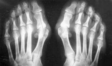Az ízületi gyulladás és ízületi tünetek differenciális diagnosztizálása