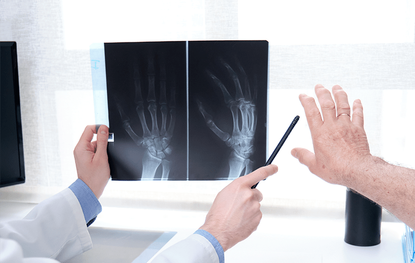 ízületi arthrosis diagnózisa