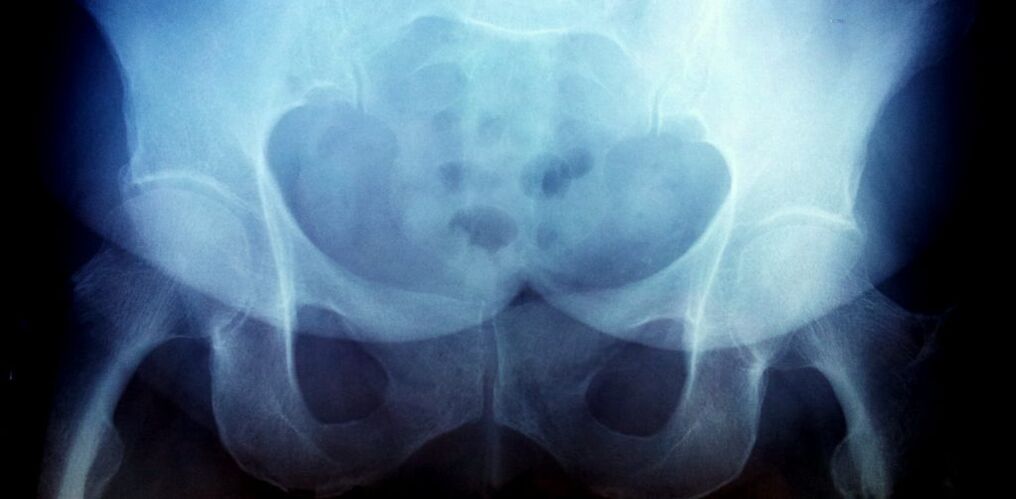 X -Ray kép a 2. fokozat artrózisával